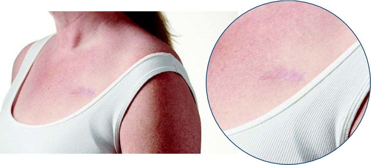 Detailed view of female patient with TV-ICD.